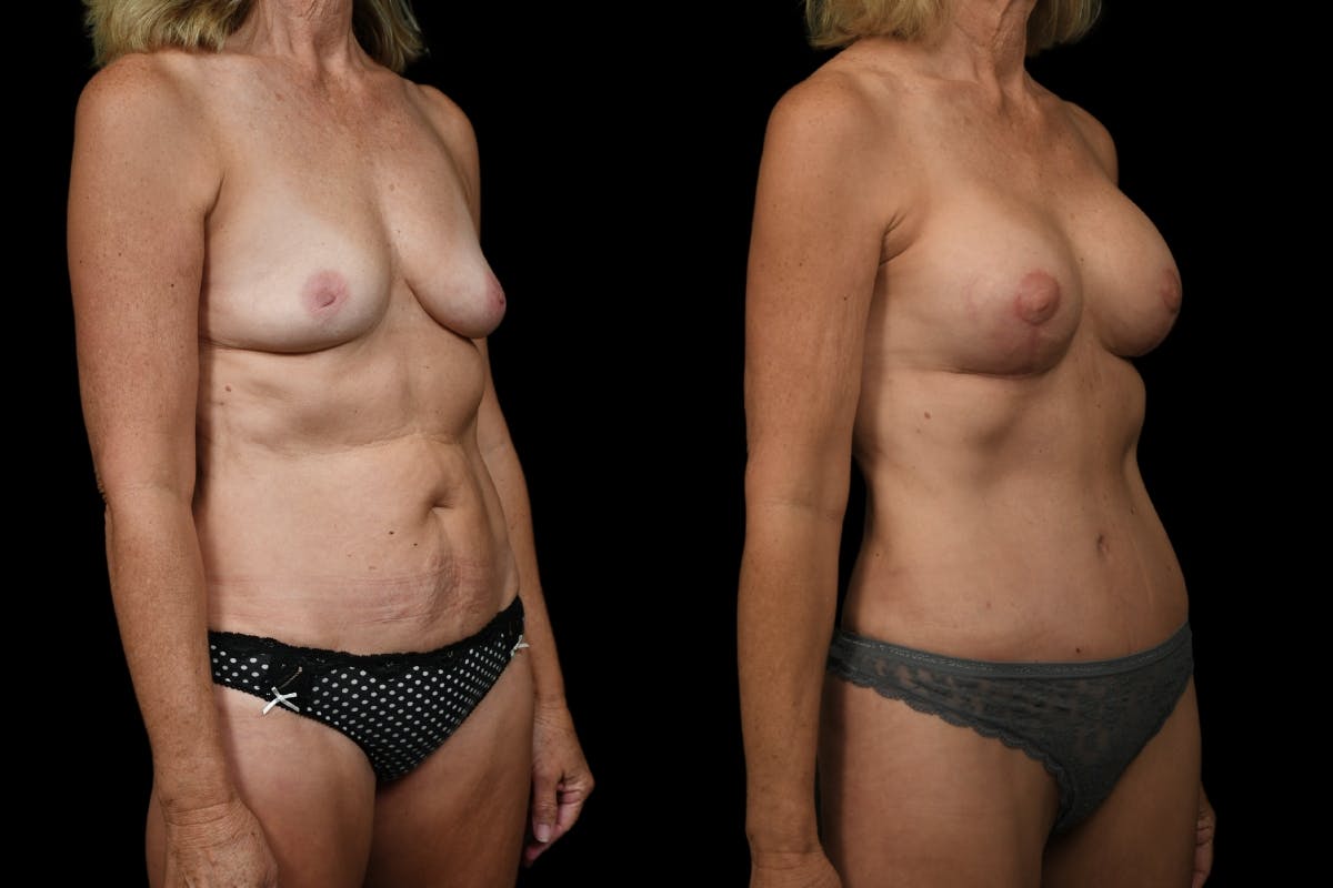 Tummy Tuck Before & After Gallery - Patient 542761 - Image 4