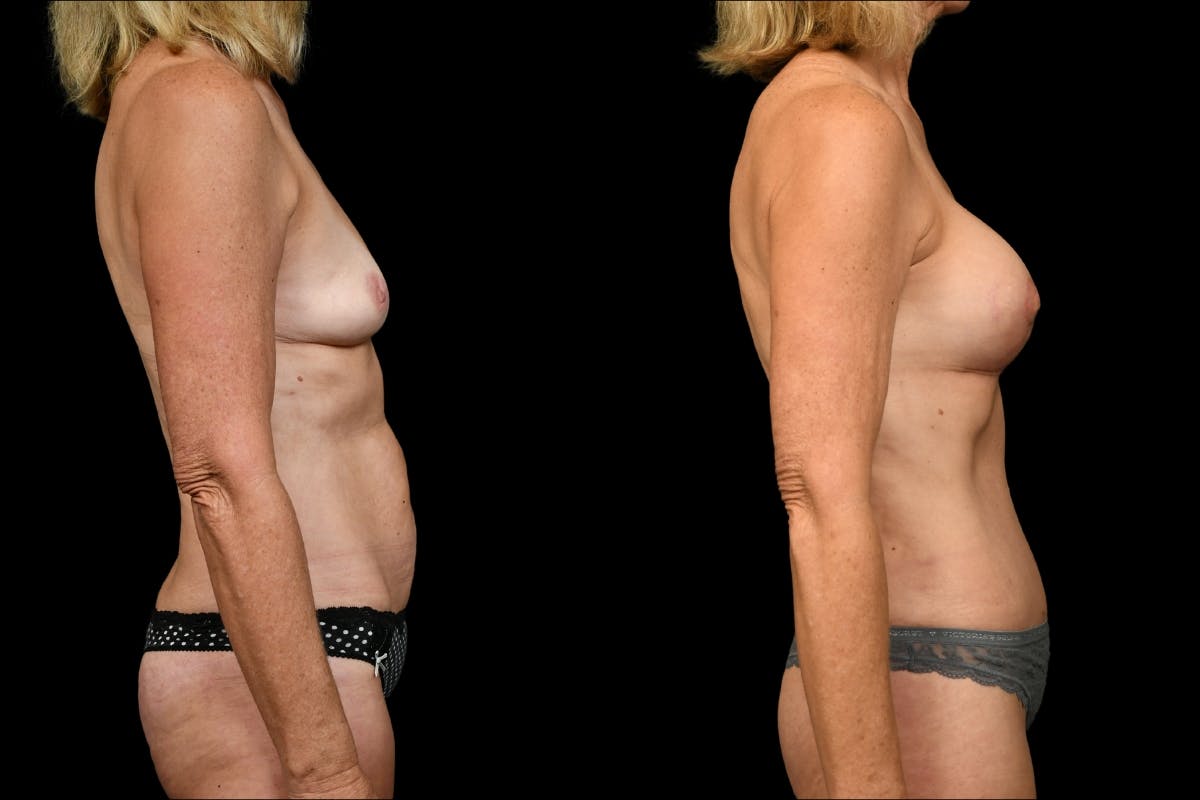 Tummy Tuck Before & After Gallery - Patient 542761 - Image 5