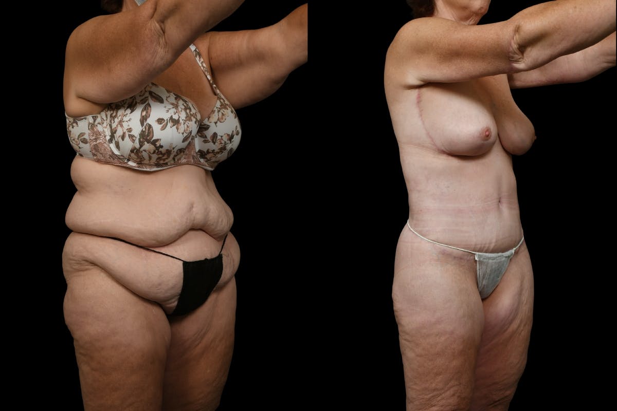 Mommy Makeover Before & After Gallery - Patient 142865 - Image 2