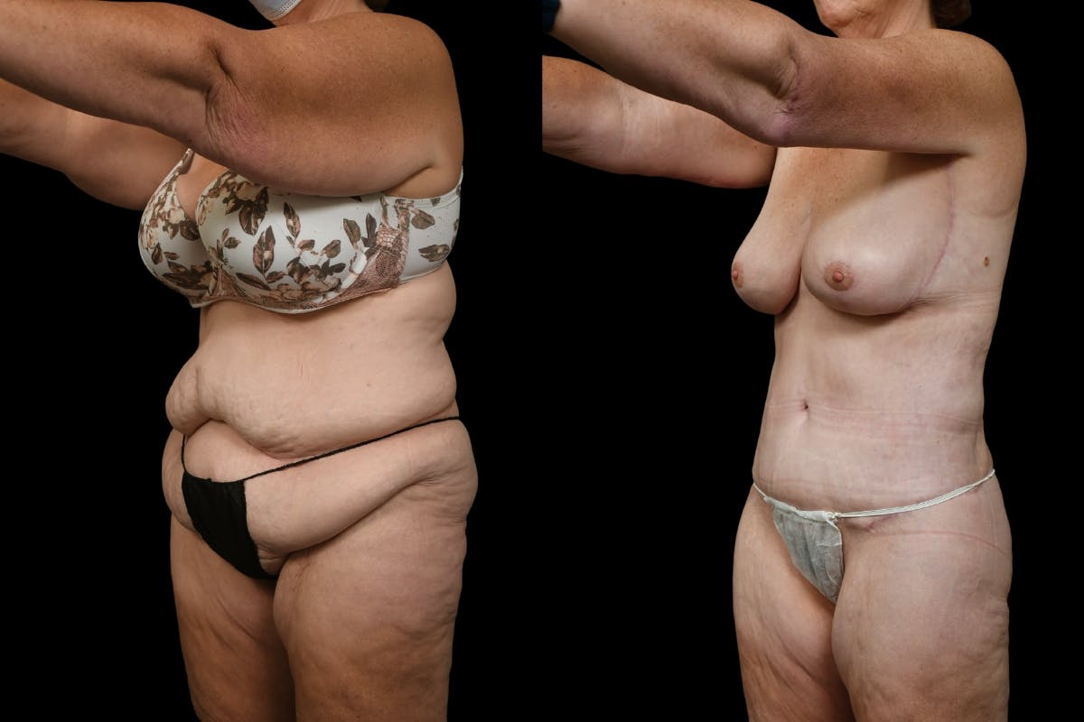 Mommy Makeover Before & After Gallery - Patient 142865 - Image 4