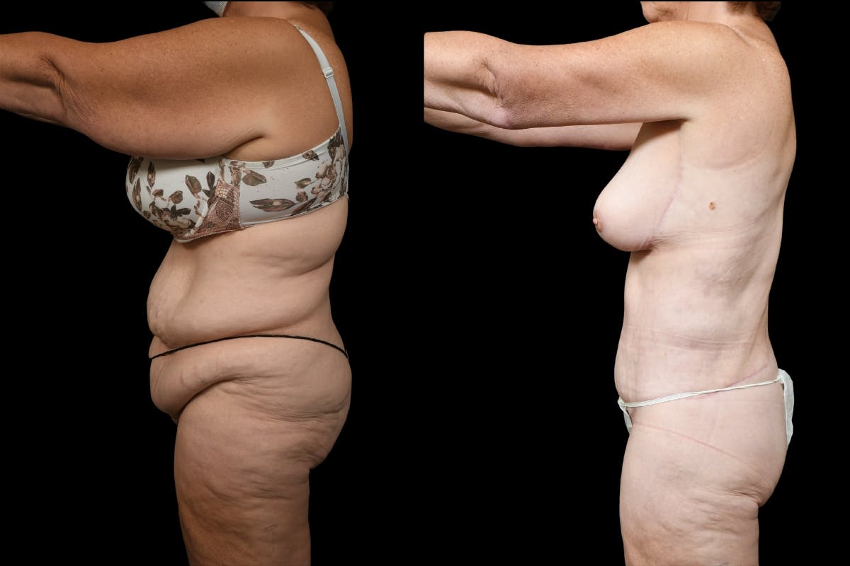 Mommy Makeover Before & After Gallery - Patient 142865 - Image 5