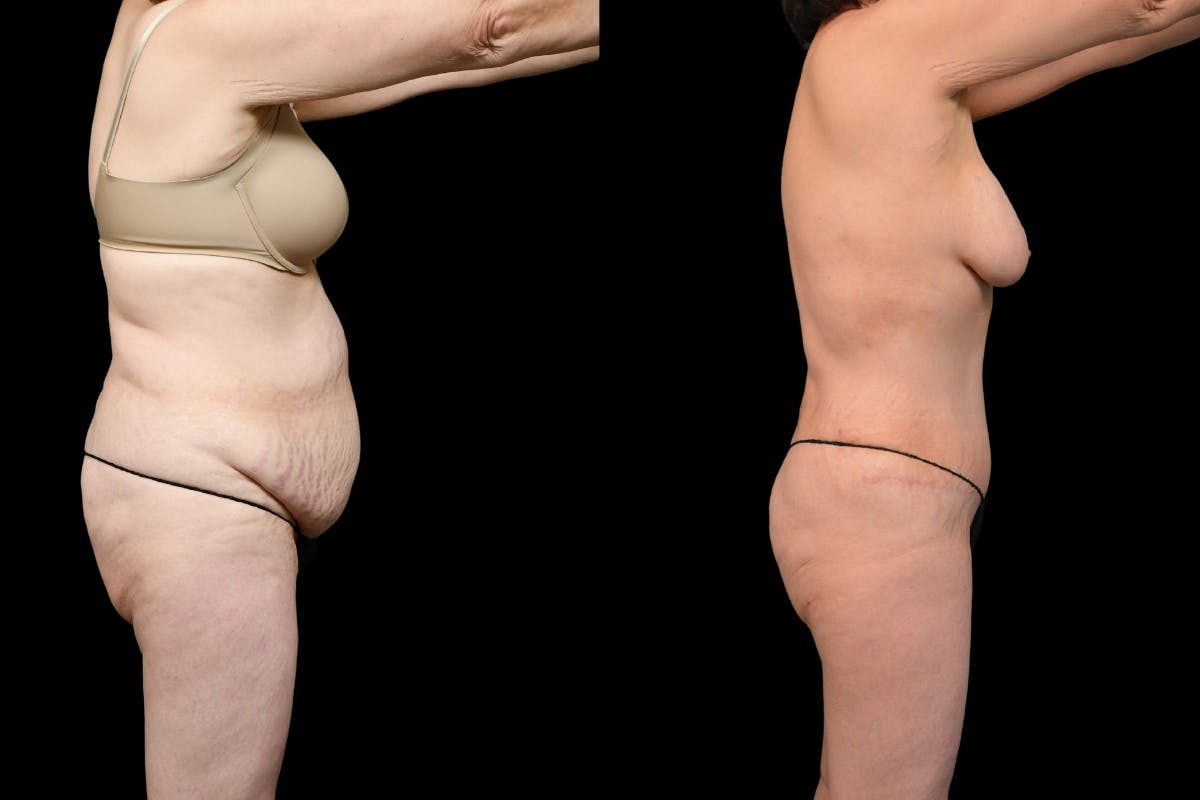 Massive Weight Loss Before & After Gallery - Patient 210587 - Image 3