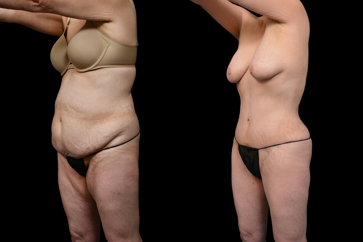 Massive Weight Loss Before & After Gallery - Patient 210587 - Image 4