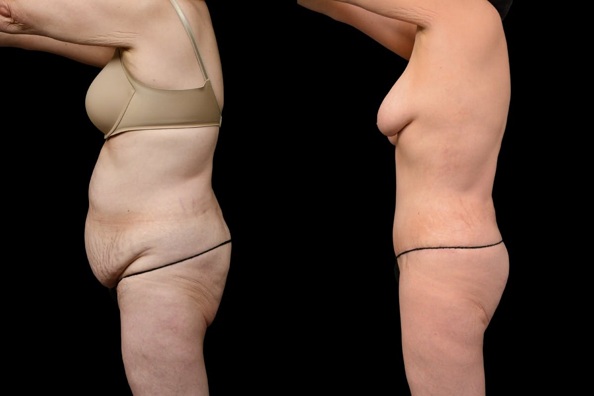 Massive Weight Loss Before & After Gallery - Patient 210587 - Image 5
