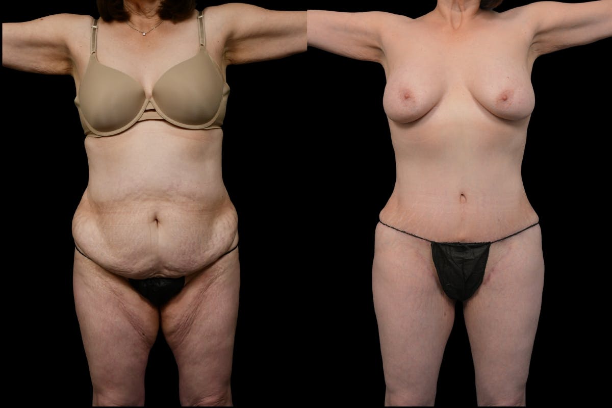 Massive Weight Loss Before & After Gallery - Patient 210587 - Image 1
