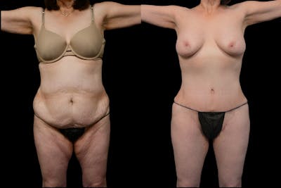Tummy Tuck Before & After Gallery - Patient 278515 - Image 1