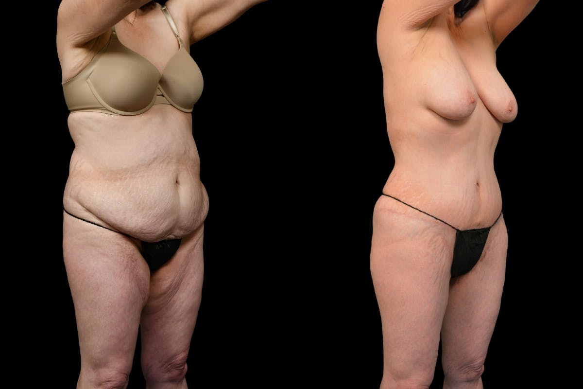 Massive Weight Loss Before & After Gallery - Patient 210587 - Image 2