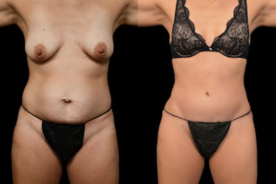 Tummy Tuck Before & After Gallery - Patient 148243 - Image 1