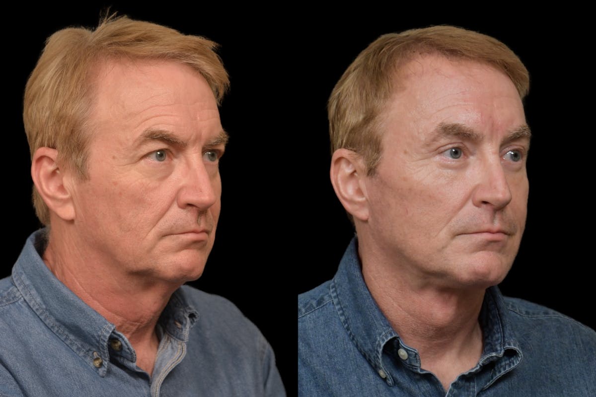 Changes Rapid Lift For Men Before & After Gallery - Patient 187783 - Image 3