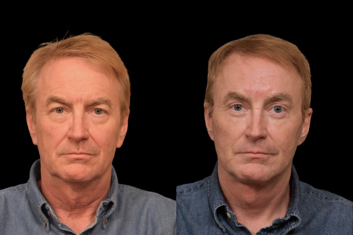 Changes Rapid Lift For Men Before & After Gallery - Patient 187783 - Image 5