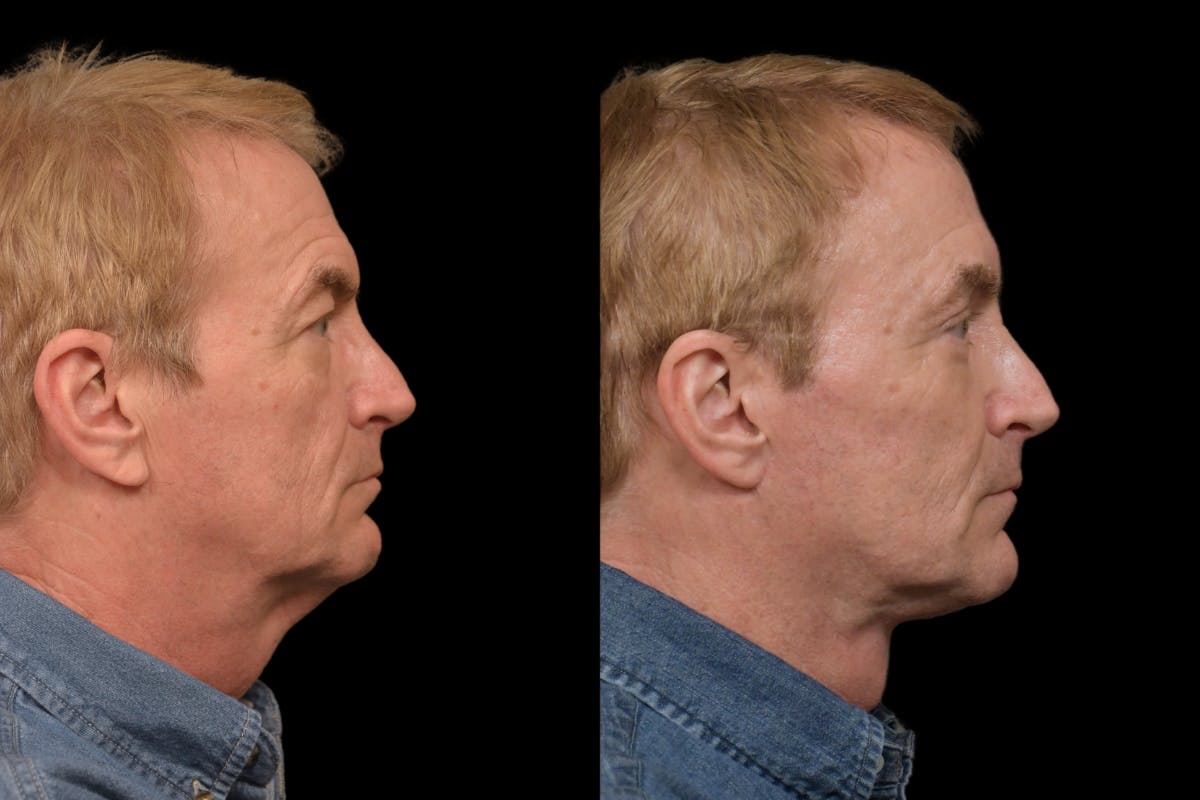 Changes Rapid Lift For Men Before & After Gallery - Patient 187783 - Image 4
