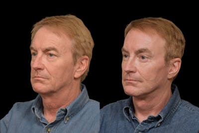 Changes Rapid Lift  Before & After Gallery - Patient 381579 - Image 1