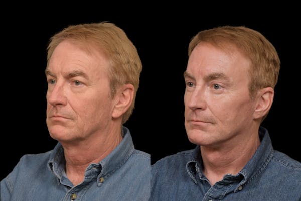Changes Rapid Lift For Men Before & After Gallery - Patient 187783 - Image 1