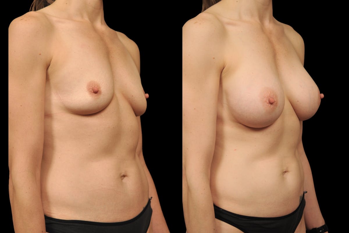 Breast Augmentation Before & After Gallery - Patient 338862 - Image 2