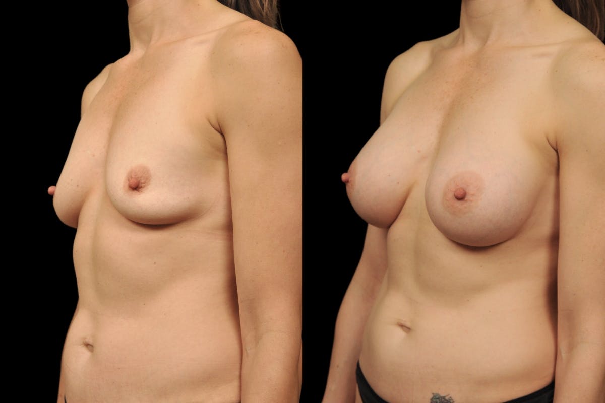 Breast Augmentation Before & After Gallery - Patient 338862 - Image 4