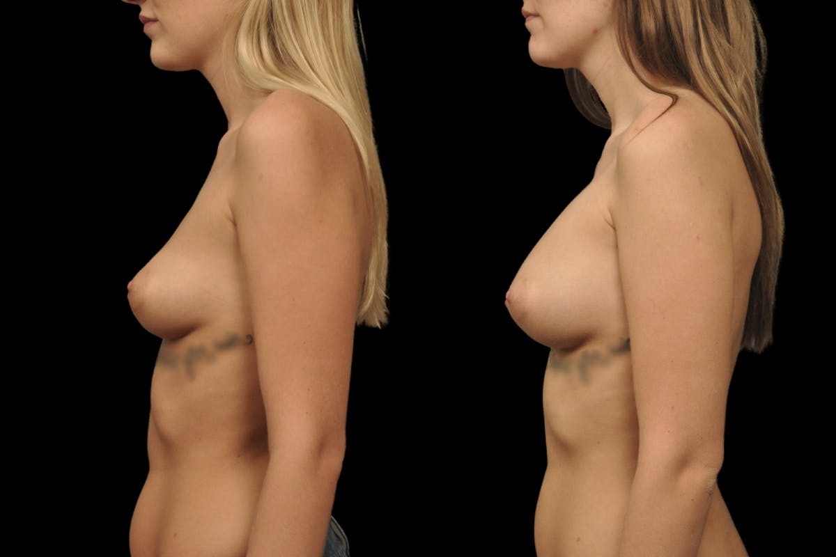 Breast Augmentation Before & After Gallery - Patient 497194 - Image 5