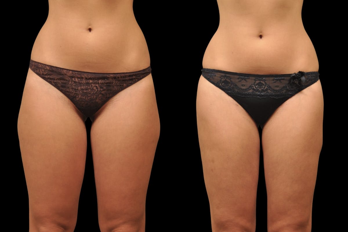 Liposuction / BodyTite Before & After Gallery - Patient 297174 - Image 1