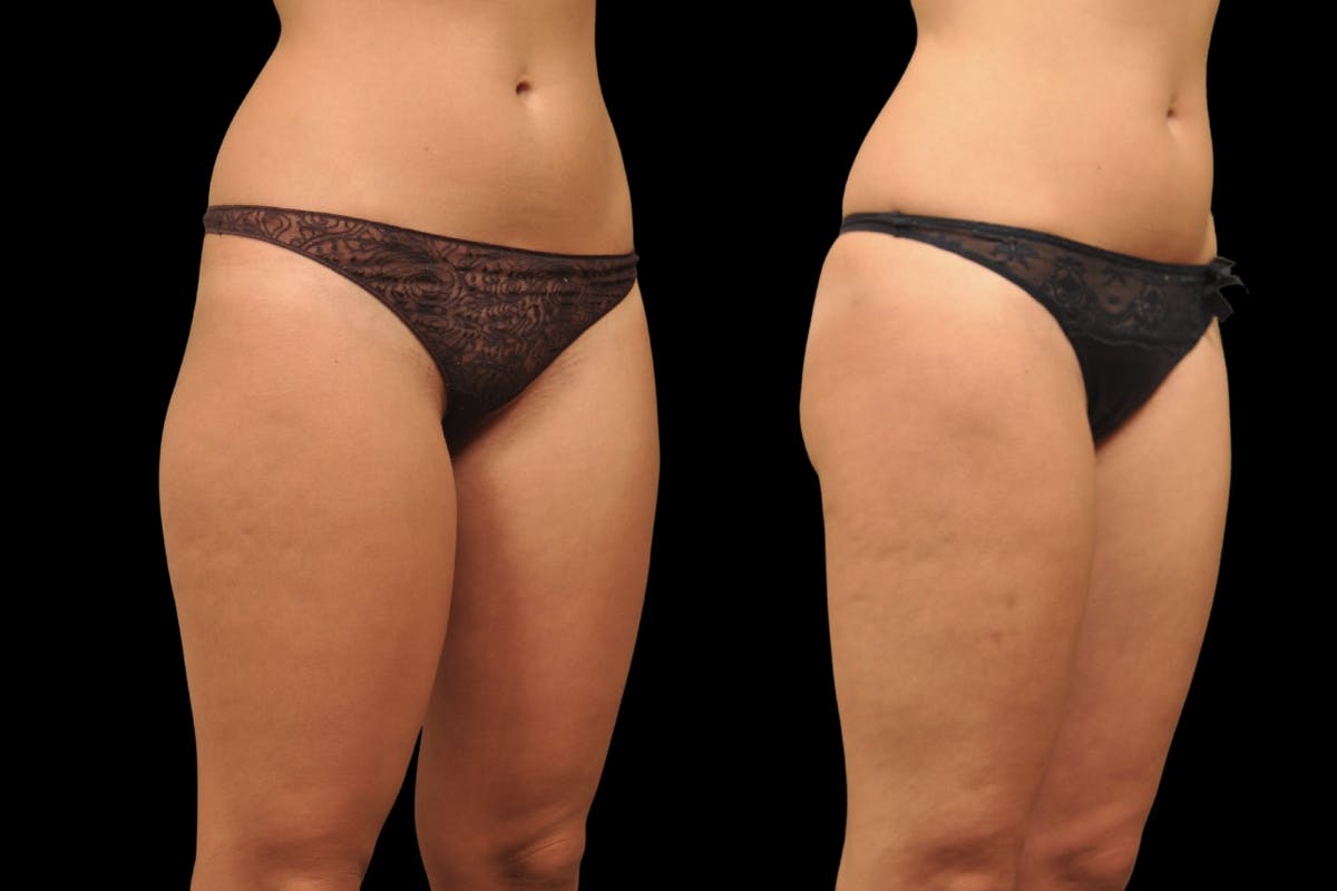 Liposuction / BodyTite Before & After Gallery - Patient 297174 - Image 2