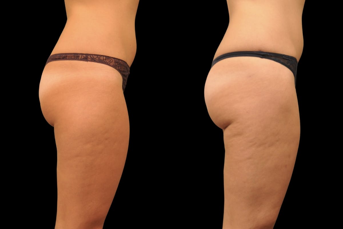Liposuction / BodyTite Before & After Gallery - Patient 297174 - Image 3