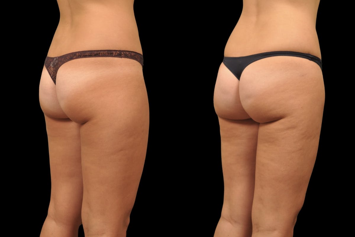 Liposuction / BodyTite Before & After Gallery - Patient 297174 - Image 4