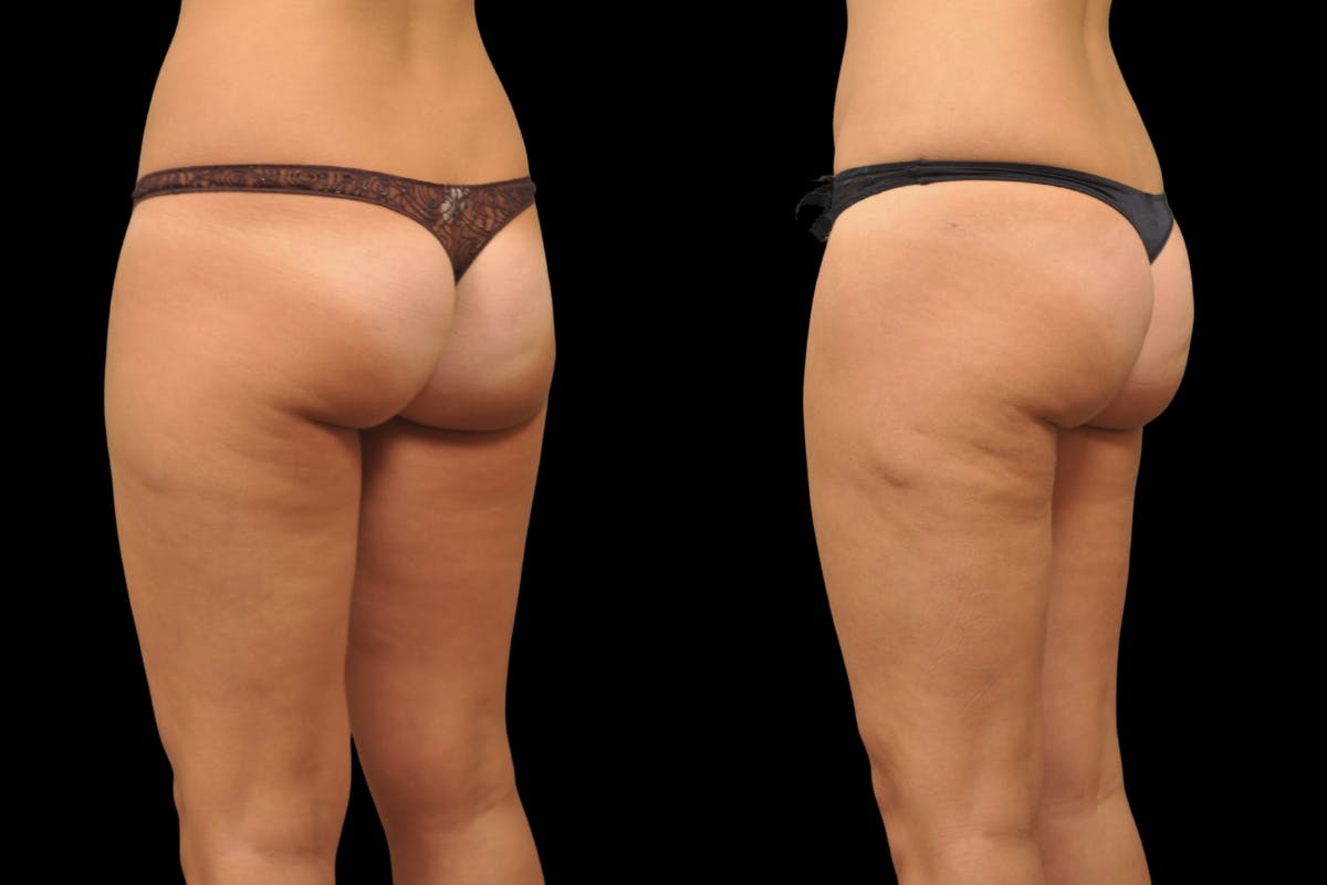 Liposuction / BodyTite Before & After Gallery - Patient 297174 - Image 5