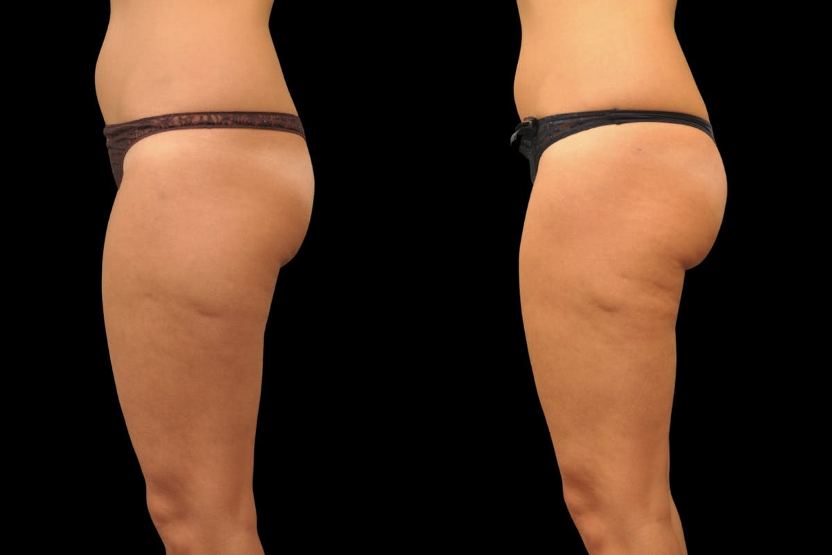 Liposuction / BodyTite Before & After Gallery - Patient 297174 - Image 6