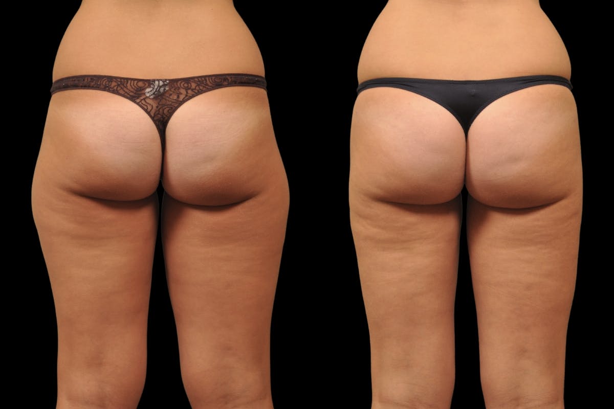 Liposuction / BodyTite Before & After Gallery - Patient 297174 - Image 7