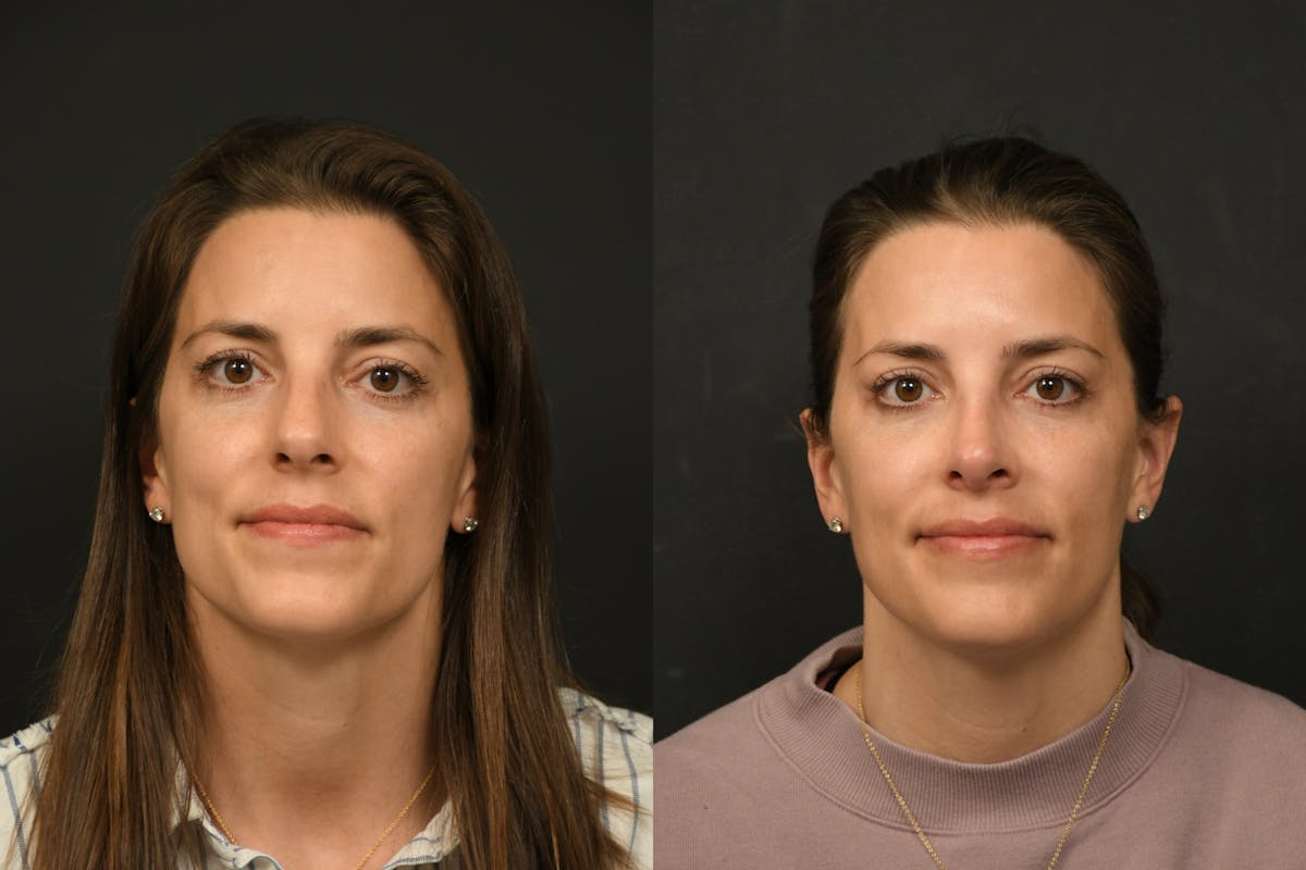Rhinoplasty Before & After Gallery - Patient 541855 - Image 5