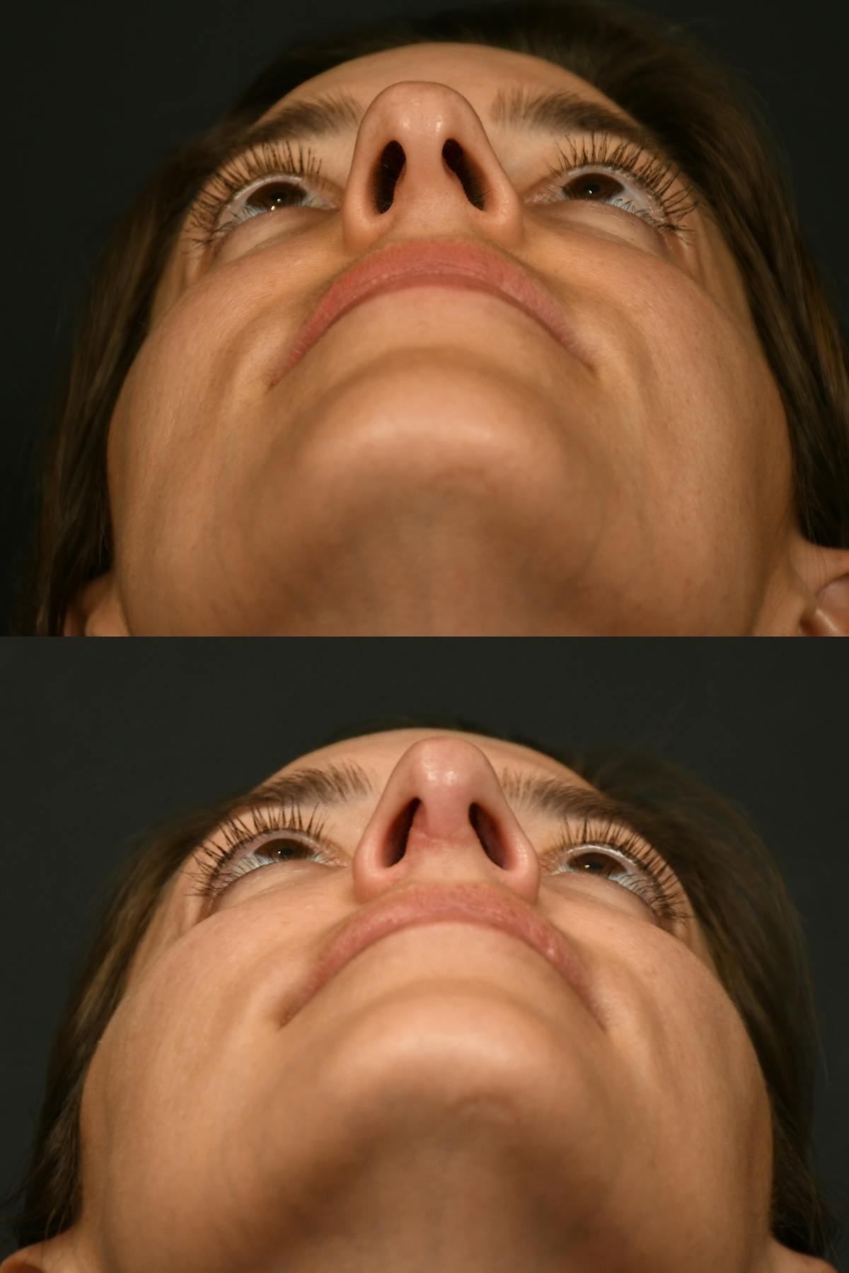 Rhinoplasty Before & After Gallery - Patient 541855 - Image 6