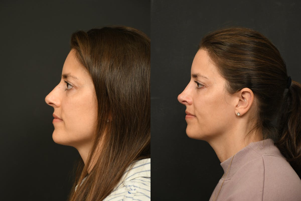 Rhinoplasty Before & After Gallery - Patient 541855 - Image 2