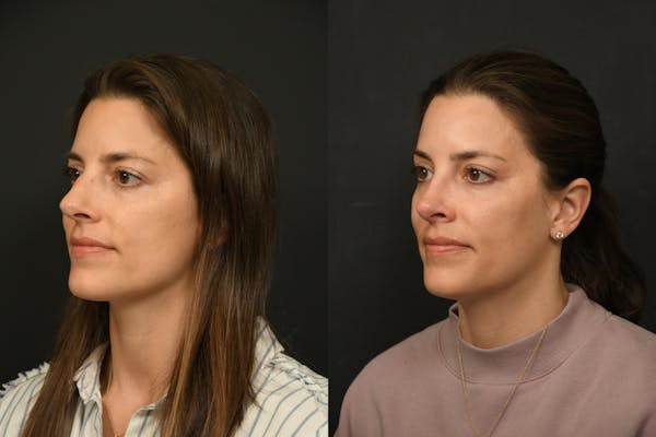 Rhinoplasty Before & After Gallery - Patient 541855 - Image 1