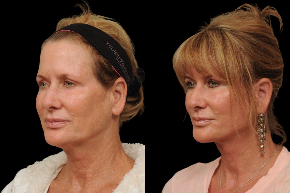 Changes Rapid Lift  Before & After Gallery - Patient 591986 - Image 1