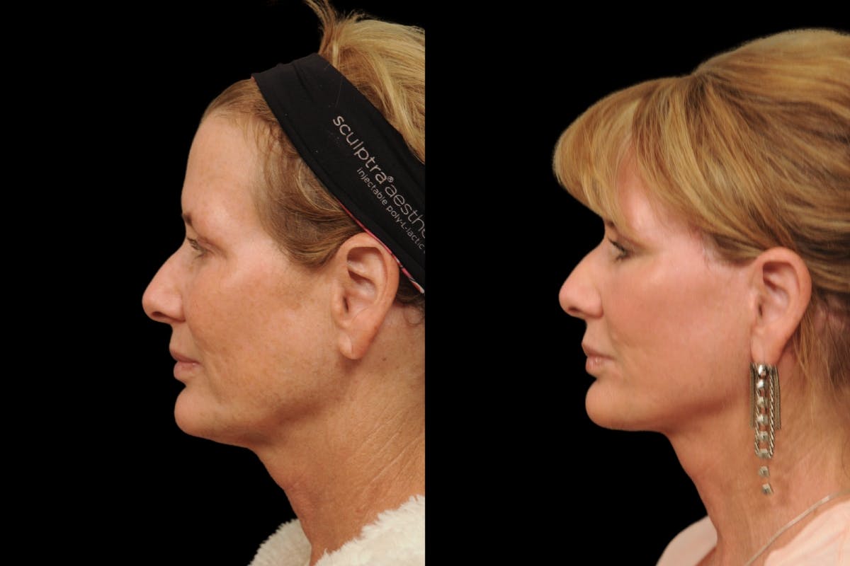 Changes Rapid Lift  Before & After Gallery - Patient 591986 - Image 2