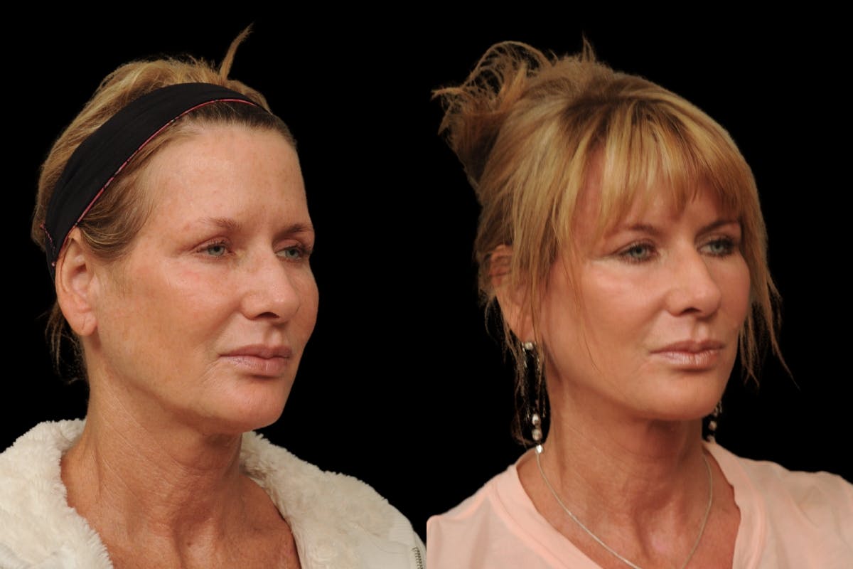 Changes Rapid Lift  Before & After Gallery - Patient 591986 - Image 3