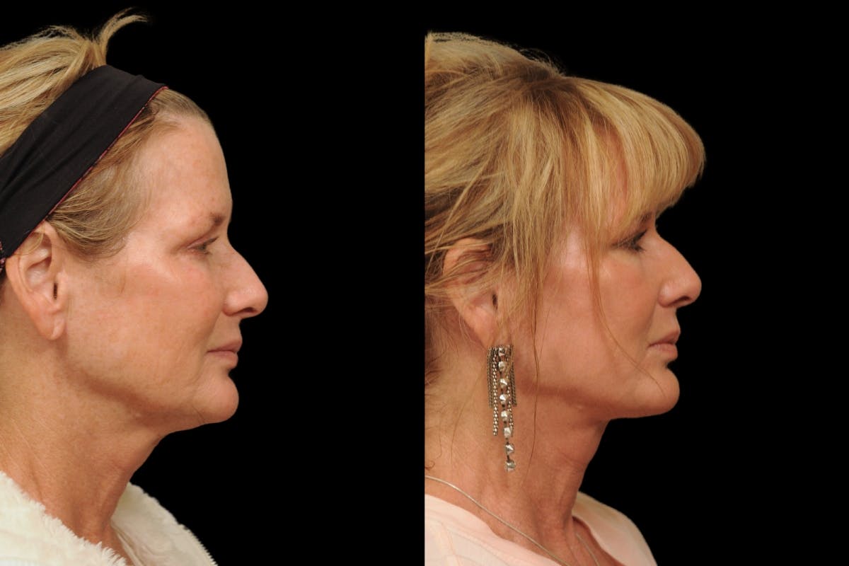 Changes Rapid Lift  Before & After Gallery - Patient 591986 - Image 4