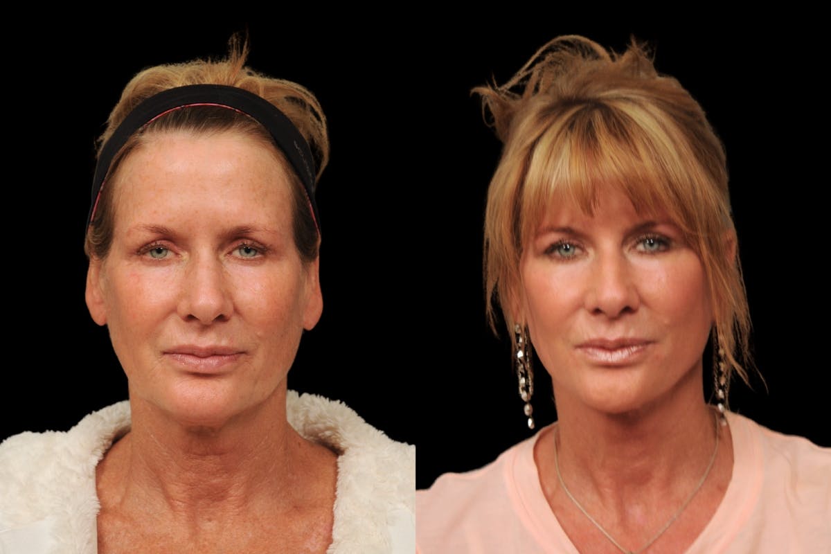 Changes Rapid Lift  Before & After Gallery - Patient 591986 - Image 5