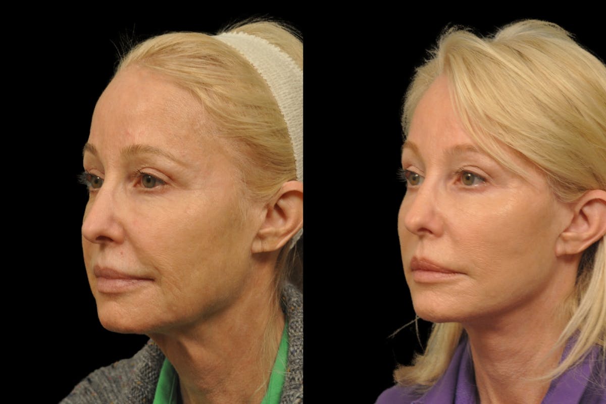 Changes Rapid Lift  Before & After Gallery - Patient 312086 - Image 1