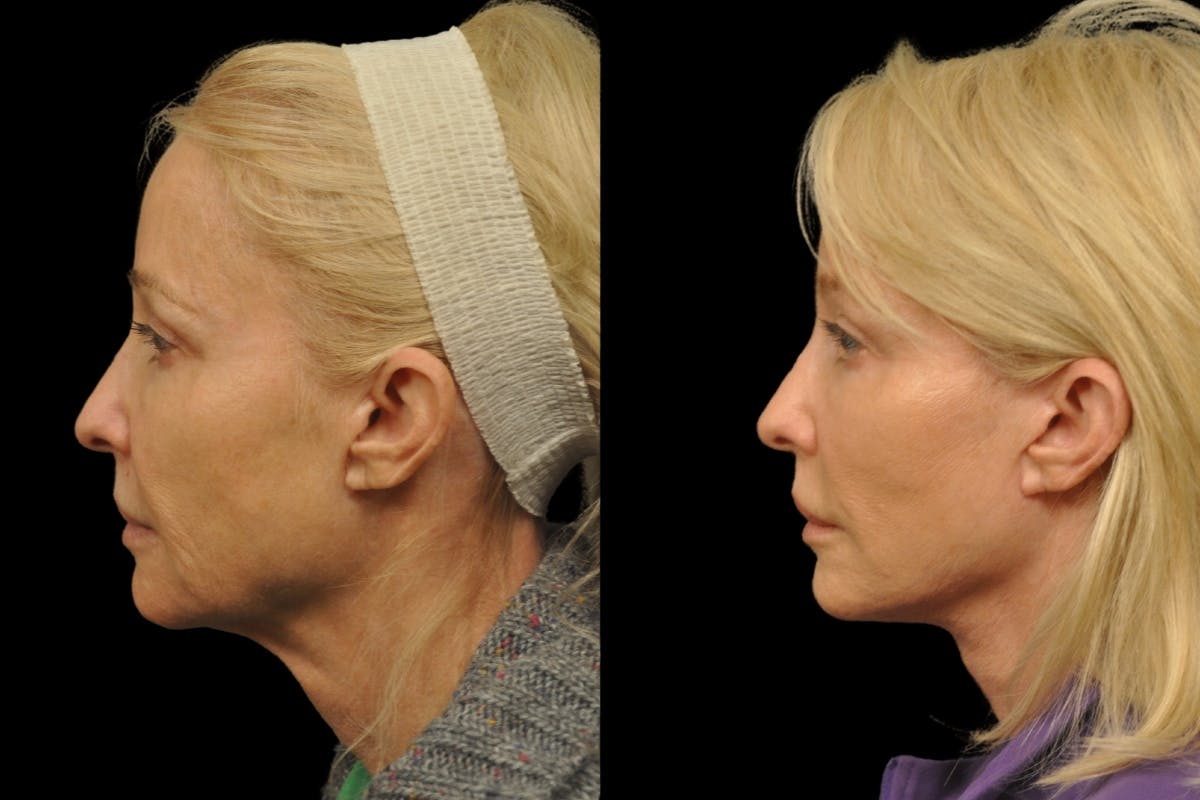 Changes Rapid Lift  Before & After Gallery - Patient 312086 - Image 2
