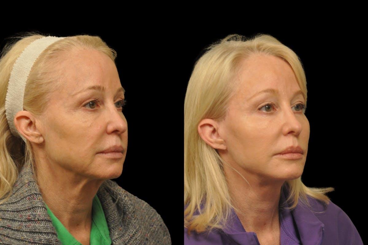 Changes Rapid Lift  Before & After Gallery - Patient 312086 - Image 3