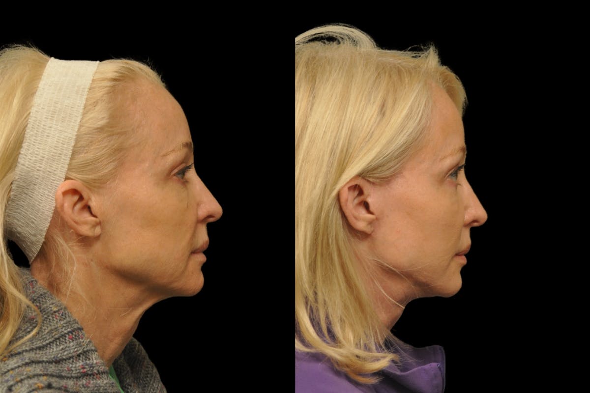 Changes Rapid Lift  Before & After Gallery - Patient 312086 - Image 4