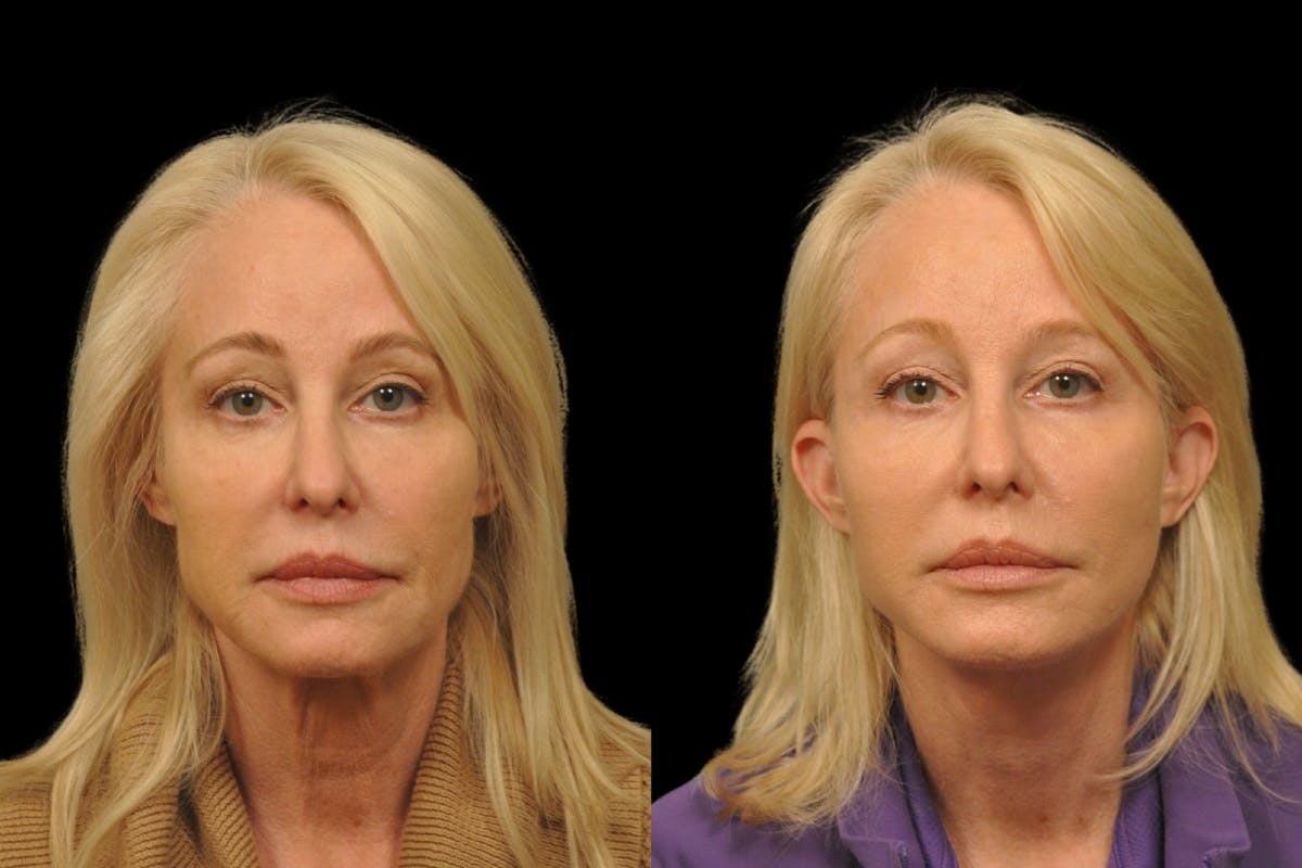 Changes Rapid Lift  Before & After Gallery - Patient 312086 - Image 5