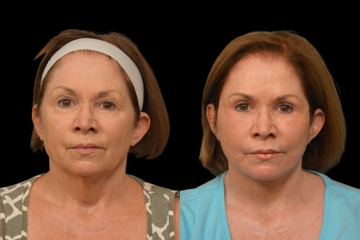 Changes Rapid Lift  Before & After Gallery - Patient 188750 - Image 5