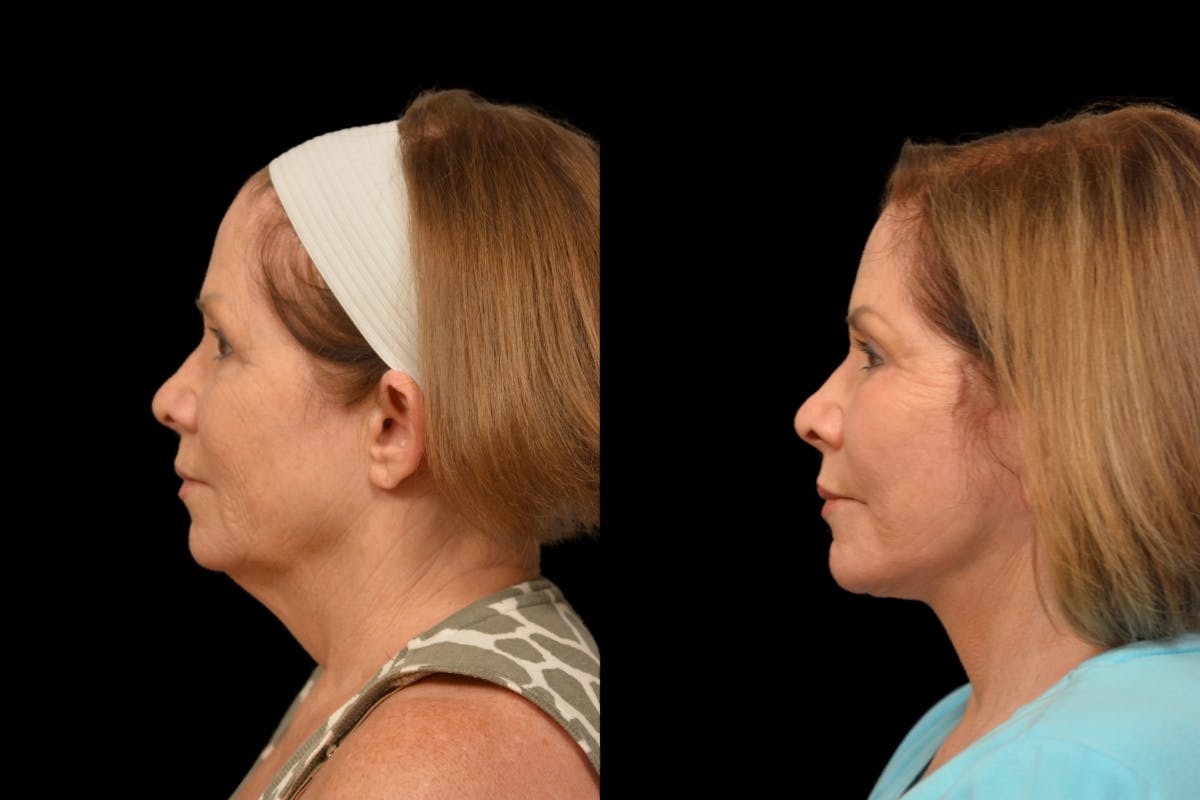 Changes Rapid Lift  Before & After Gallery - Patient 188750 - Image 2
