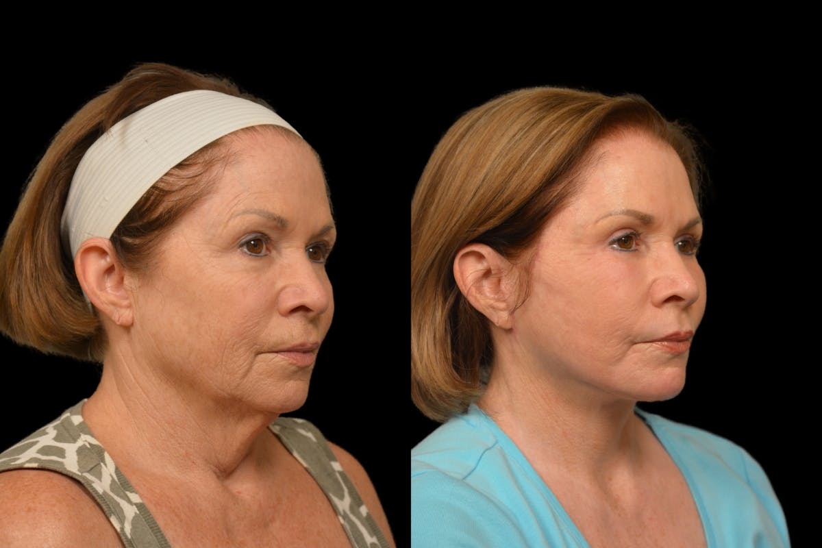 Changes Rapid Lift  Before & After Gallery - Patient 188750 - Image 3