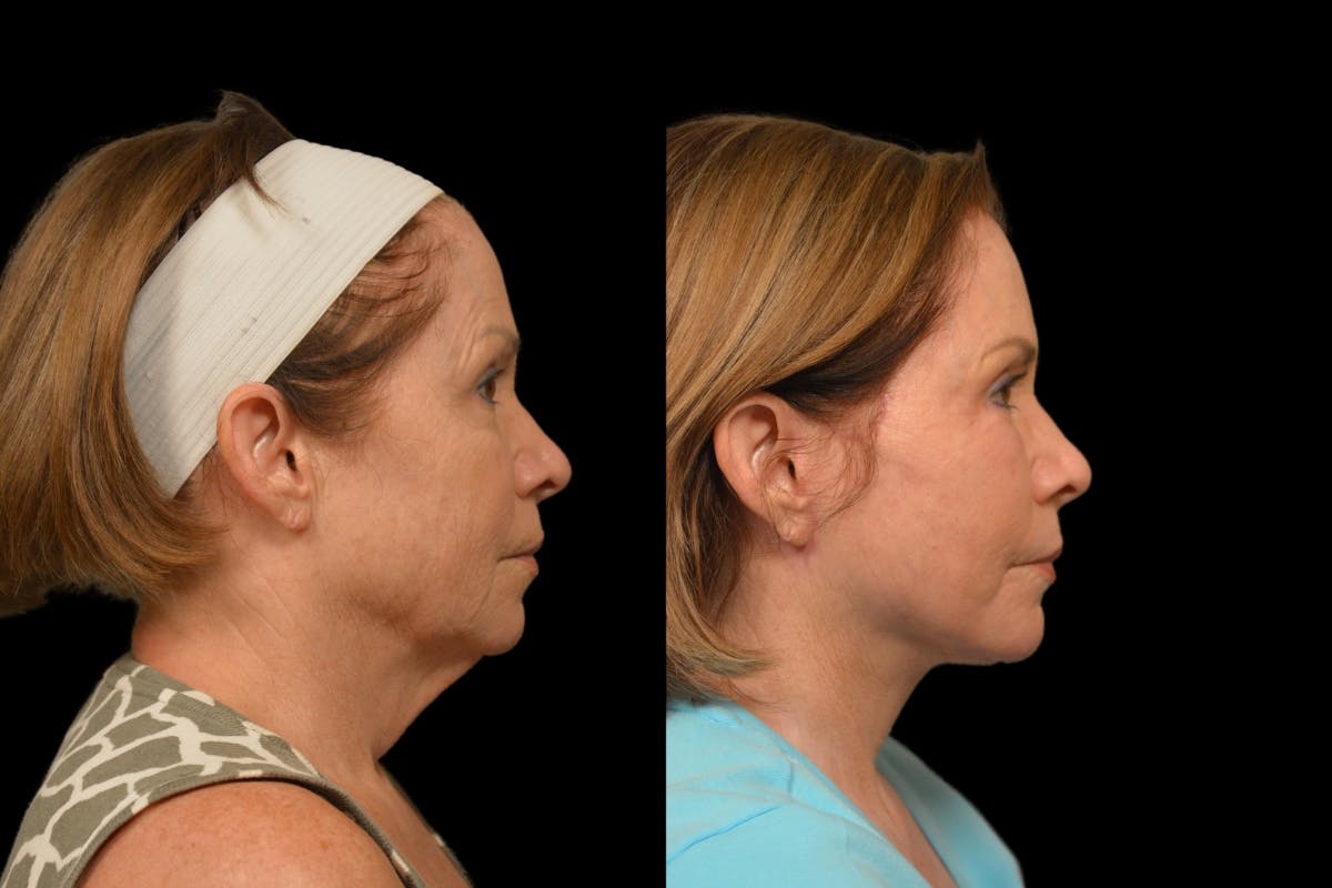 Changes Rapid Lift  Before & After Gallery - Patient 188750 - Image 4