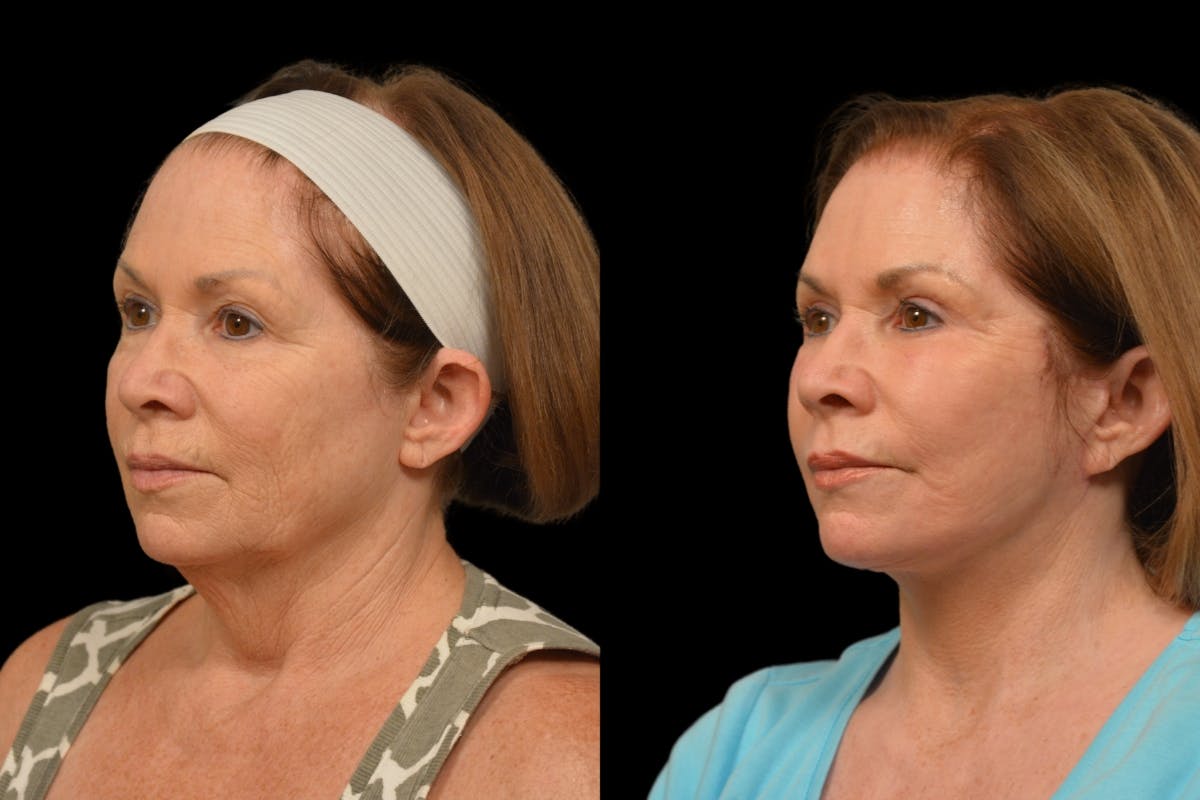 Changes Rapid Lift  Before & After Gallery - Patient 188750 - Image 1