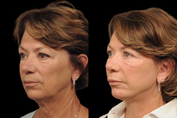 Changes Rapid Lift  Before & After Gallery - Patient 371576 - Image 1