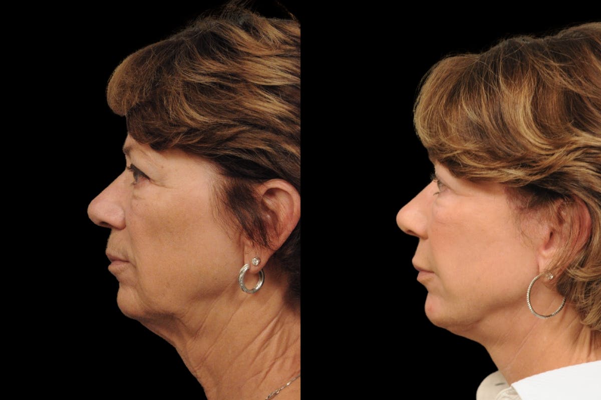 Changes Rapid Lift  Before & After Gallery - Patient 371576 - Image 2