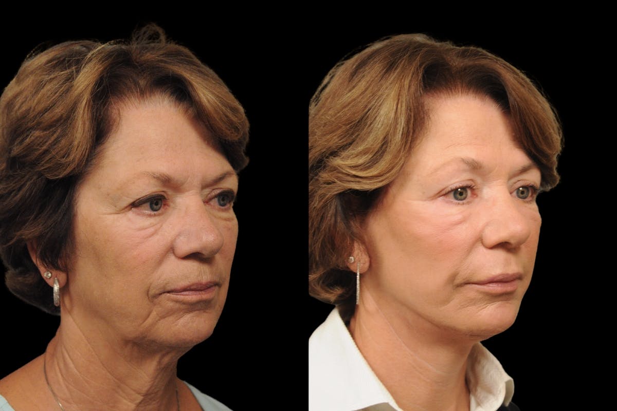 Changes Rapid Lift  Before & After Gallery - Patient 371576 - Image 3