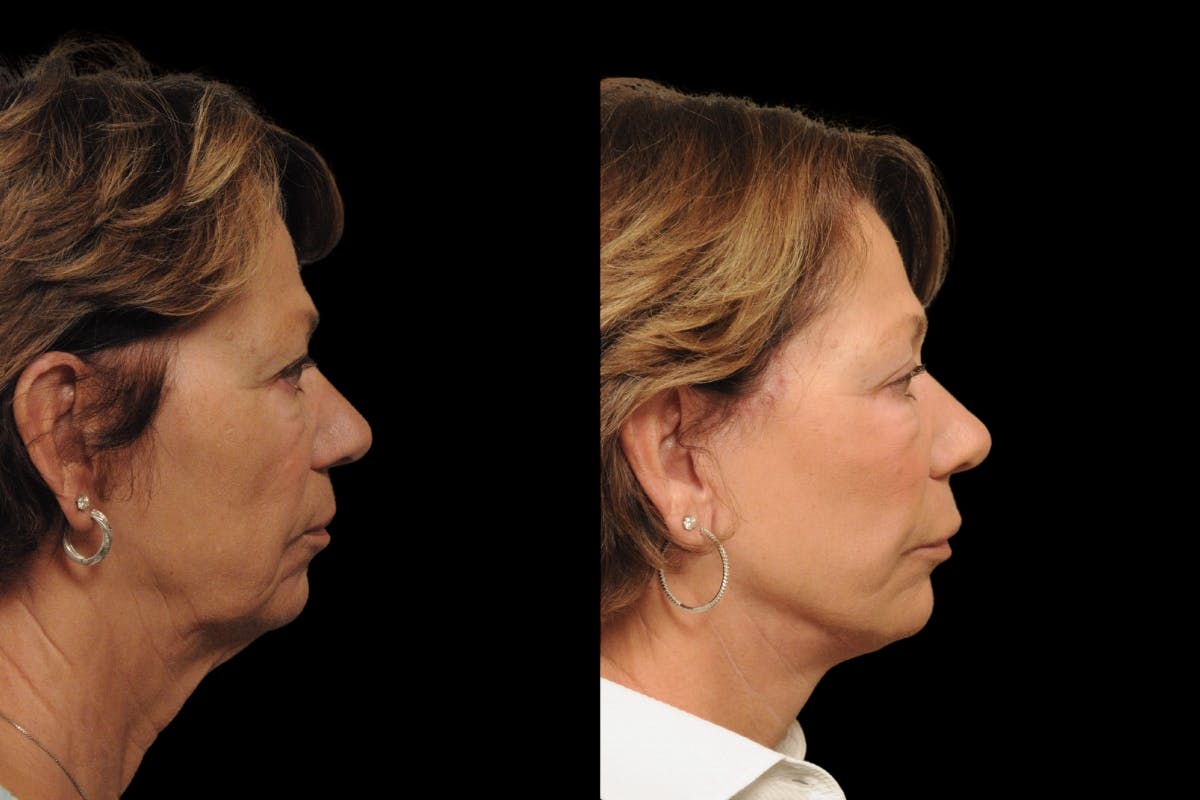 Changes Rapid Lift  Before & After Gallery - Patient 371576 - Image 4